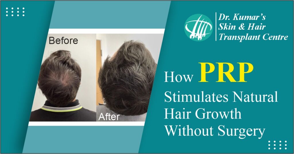 How PRP Stimulates Natural Hair Growth Without Surgery