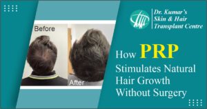 How PRP Stimulates Natural Hair Growth Without Surgery