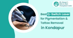 Best Q-Switch Laser for Pigmentation & Tattoo Removal In Kondapur