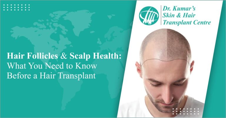 What You Need to Know Before a Hair Transplant