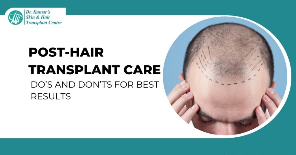 Post-Hair Transplant Care Do’s and Don’ts for Best Results