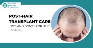 Post-Hair Transplant Care Do’s and Don’ts for Best Results