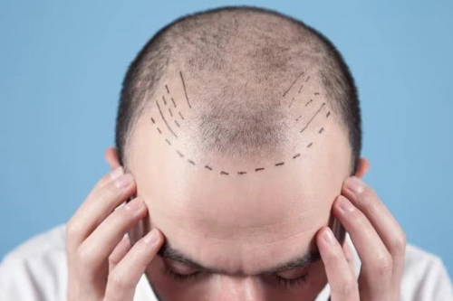 Hair Transplant in Kondapur