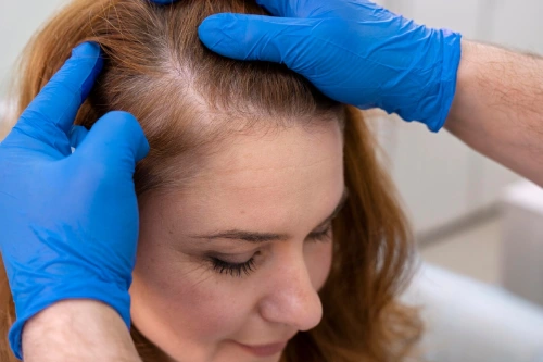Female Hair Transplant in Hyderabad