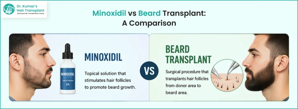 Minoxidil Vs Beard Transplant: A Comparison