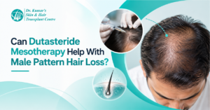 Can Dutasteride Mesotherapy Help With Male Pattern Hair Loss